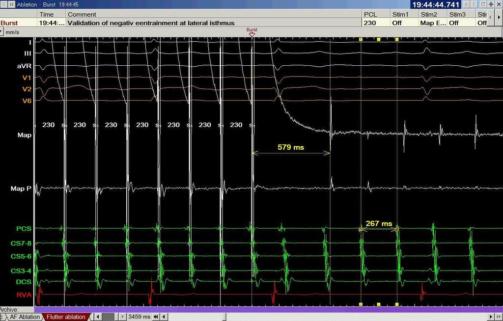 Entrainment from lateral CTI