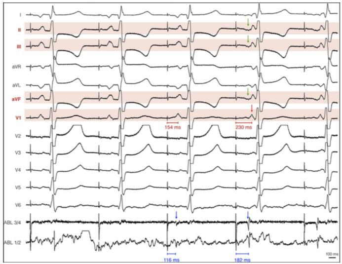 V1 jump during LAA pacing V1 jump and V1 delay are novel real-time electrocardiography criteria allowing fast