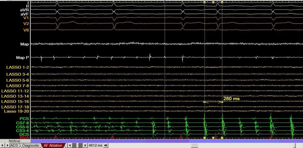 Organization of AF to atrial