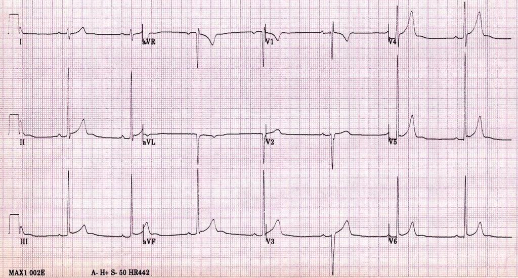 Right axis deviation Incomplete RBBB SV1 ER RV6