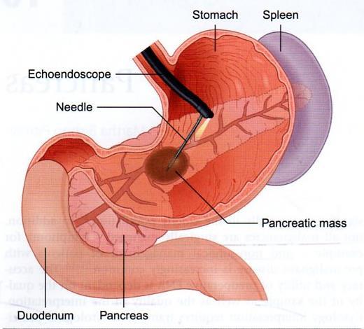 EUS-FNA
