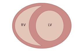 Η δεξιά κοιλία Εικόνα 5: Σχηματική απεικόνιση δεξιάς(rv) και αριστεράς(lv) κοιλίας. Η δεξιά κοιλία έχει σχήμα μηνοειδές και χωρίζεται από την αριστερά κοιλία με το μεσοκοιλιακό διάφραγμα.