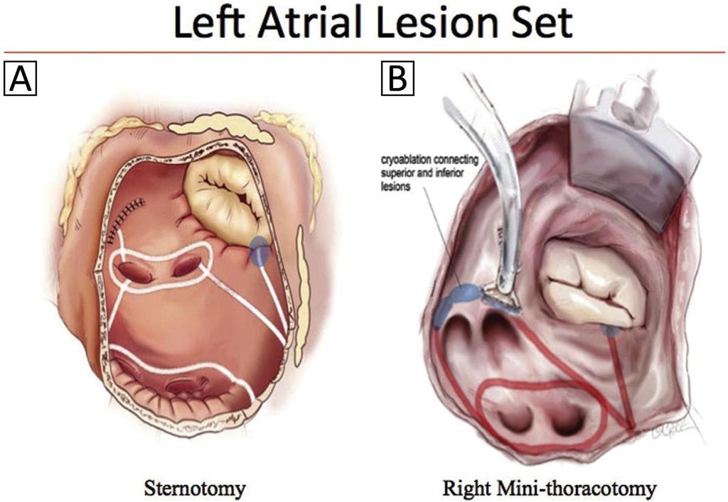 Fig 1. Left atrial lesion sets for Cox maze IV procedure.