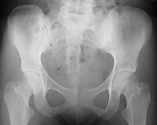 sclerosis of the sacroiliac joint.
