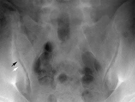 Manifest abnormalities in the form of erosion and sclerosis