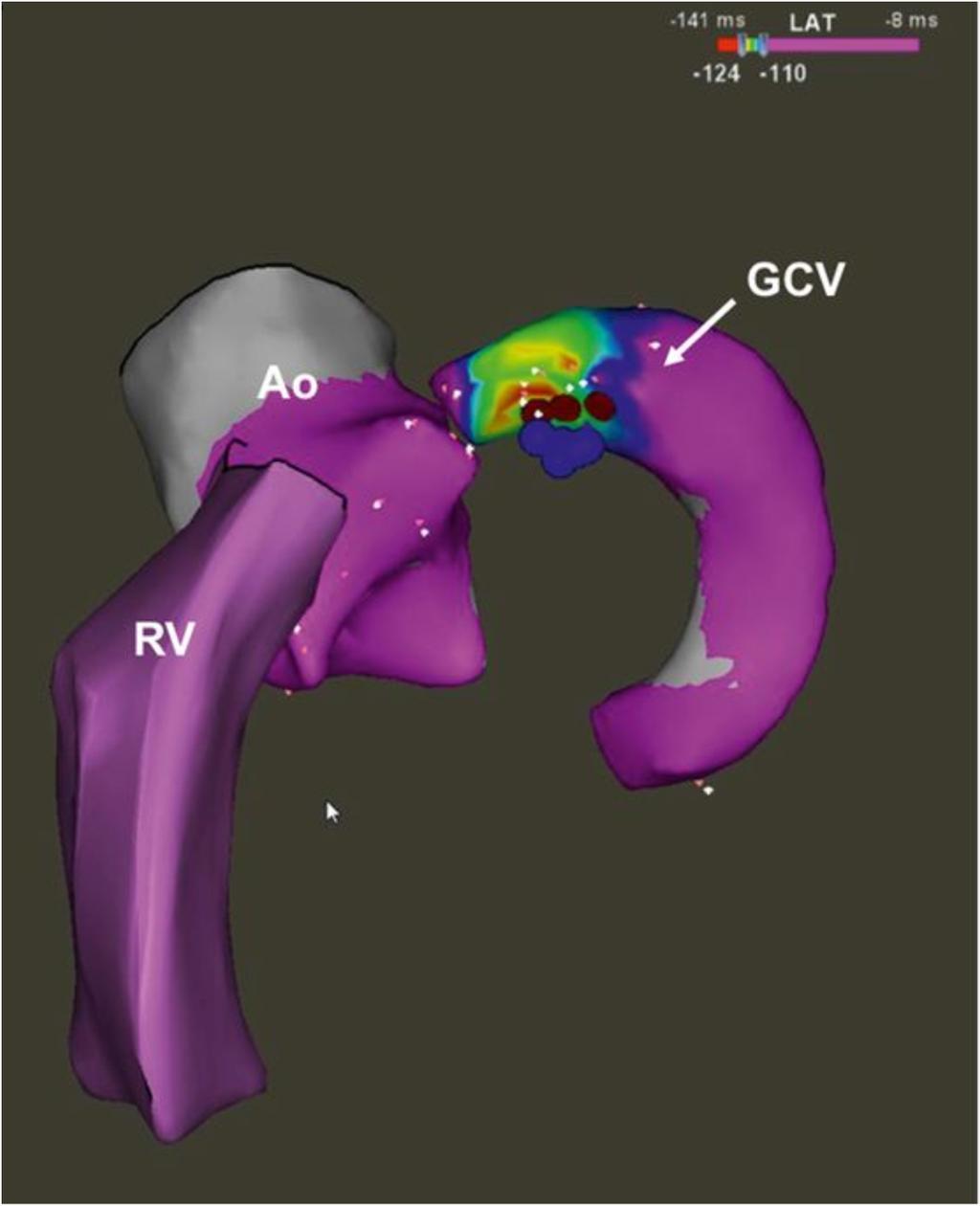 Catheter Ablation of Ventricular Tachycardia in