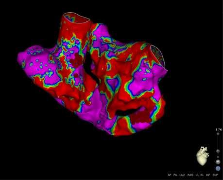 mapping Left atrial