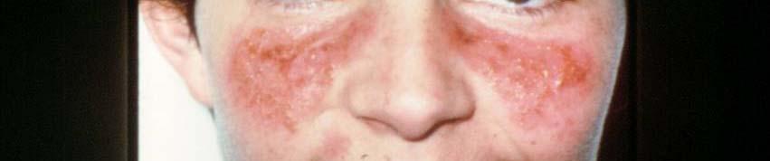 Lymphadenopathy, and a malar rash.
