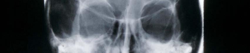 His sinus films show opacification of the left maxillary