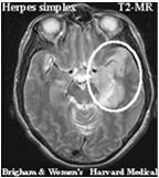 ψυχοκινητική καθυστέρηση, σπασμούς Ερπητική εγκεφαλίτιδα Διάγνωση PCR MRI δείχνει βλάβες στους κροταφικούς λοβούς ΗΕΓ υψίσυχνα κύματα που