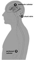2010;362:146 54 Eπεμβάσεις στη νευροχειρουργική CSF Shunt και Drains (Εxternal ventricular drains EVD ή