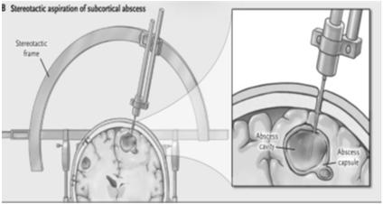 Διάγνωση CT και MRI εγκεφάλου Brouwer MC, et al. N Engl J Med. 2014;371:1758 Θεραπεία Χειρουργική αντιμετώπιση,εκτός εαν είναι μικρά (<2.