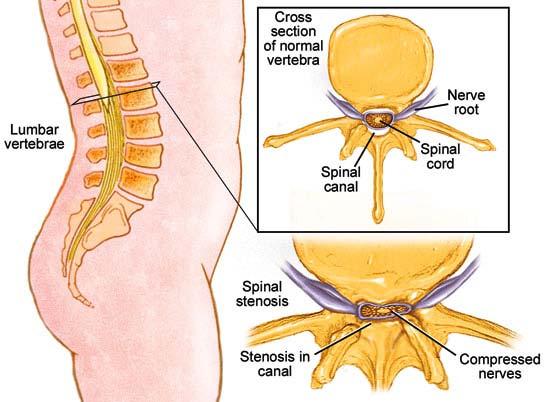 curvature "swayback" Stenosis of