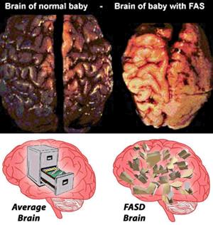 Πώς εκδηλώνεται η βλάβη στον εγκέφαλο των παιδιών με FASD