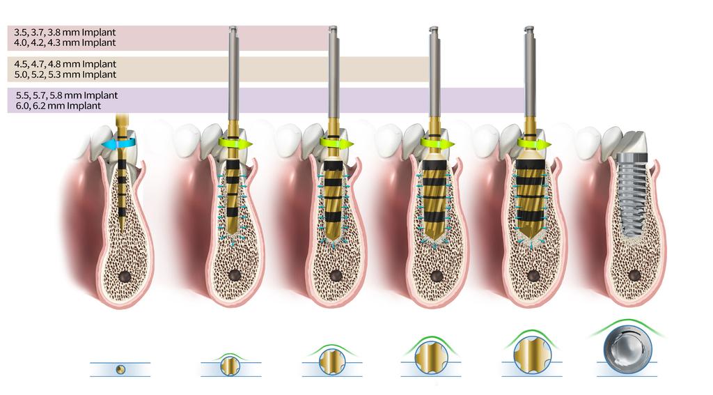 Εμφύτευμα 3,5, 3,7, 3,8 mm Εμφύτευμα 4,0, 4,2, 4,3 mm Εμφύτευμα 4,5, 4,7, 4,8 mm Εμφύτευμα 5,0, 5,2, 5,3 mm Εμφύτευμα 5,5, 5,7, 5,8 mm Εμφύτευμα 6,0, 6,2, mm 4.