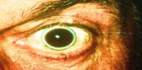 Xanthelasma B.