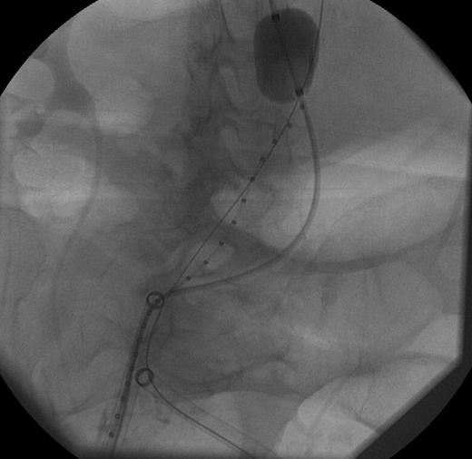 θηκάρια (sheaths) -24Fr Aortic occlusion