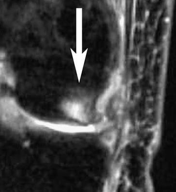 Οστεοαρθρίτιδα / εκφύλιση MRI πρώιμα ευρήματα: Υμενίτιδα,