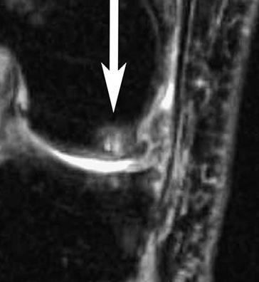 in knee osteoarthritis determined by MRI Dong etal, 2017