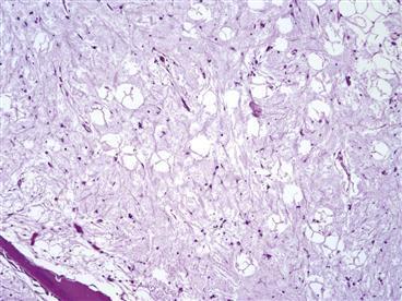 Οστικό οίδημα Curtiss PH etal: Transitory demineralization of the hip in pregnancy. A report of three cases.