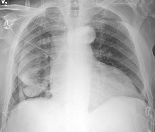 The unexpandable lung.