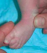 Ponseti IV. Clubfoot management.