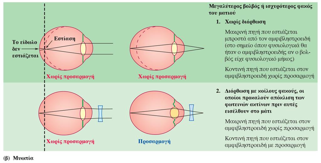 Εμμετρωπία, μυωπία και υπερμετρωπία Στην εικόνα