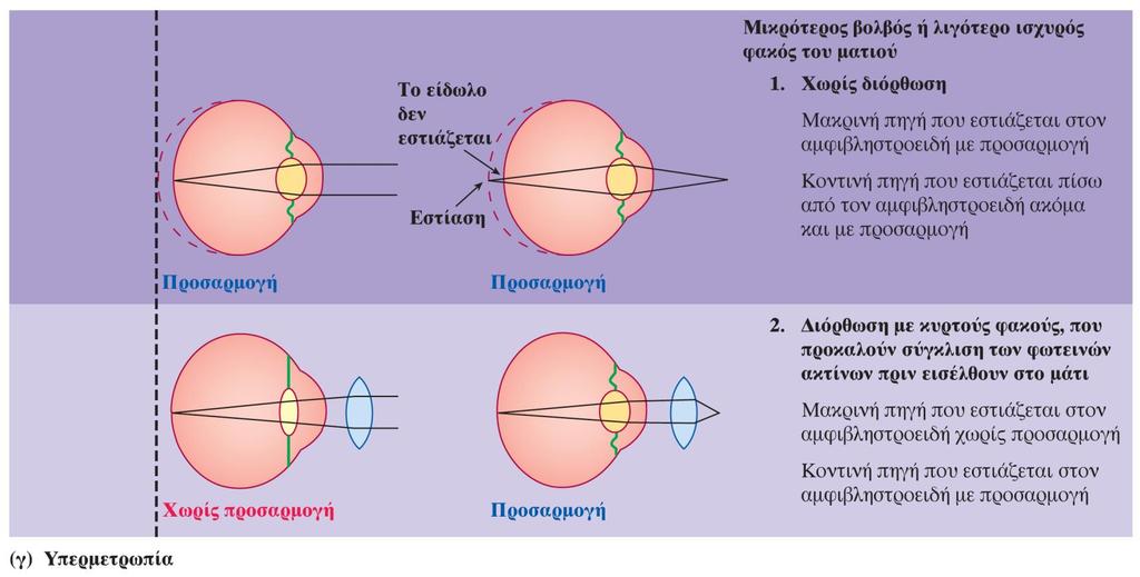 Εμμετρωπία, μυωπία και υπερμετρωπία Στην εικόνα συγκρίνονται η κοντινή και η μακρινή όραση για (γ) το υπερμετρωπικό μάτι τόσο (1) χωρίς διόρθωση όσο (2) μετά από διόρθωση με φακούς.