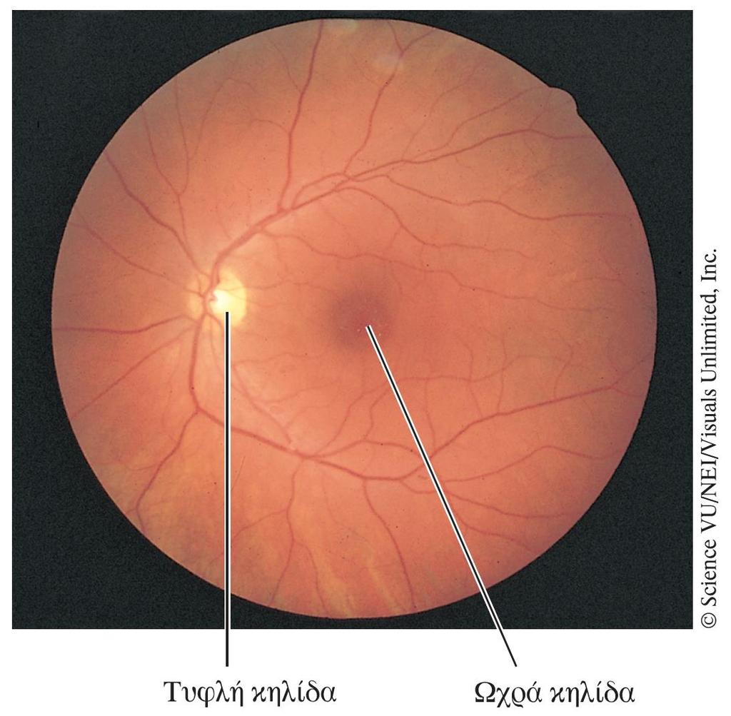Εικόνα του αμφιβληστροειδούς κατά την οφθαλμοσκόπηση Με το οφθαλμοσκόπιο, ένα όργανο που φέρει πηγή φωτός, μπορούμε