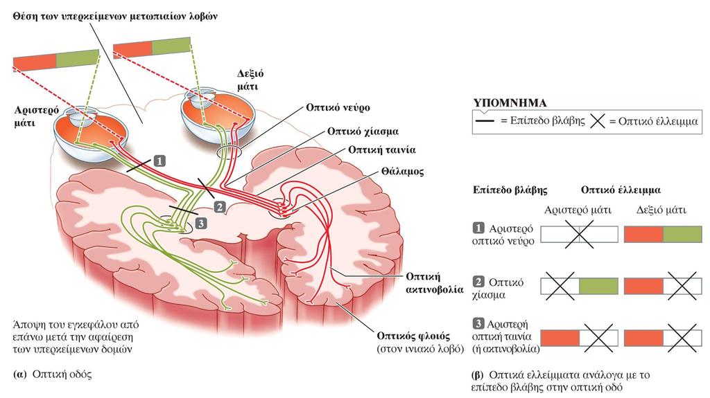 Η οπτική οδός και τα ελλείμματα οπτικού πεδίου από βλάβες της σε διάφορα επίπεδα (α) Σημειώστε ότι το αριστερό ημιμόριο του οπτικού φλοιού του ινιακού λοβού λαμβάνει οπτική πληροφορία από το δεξιό