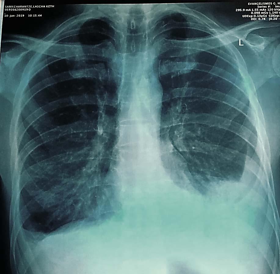 Παρουσίαση Ασθενής 25 ετών, καπνιστής μεταφέρθηκε στον θάλαμο μετά από 9 μέρες νοσηλείας στην ΜΕΘ λόγω κρίσης βρογχικού άσθματος (είχε διασωληνωθεί στο ΤΕΠ) Την