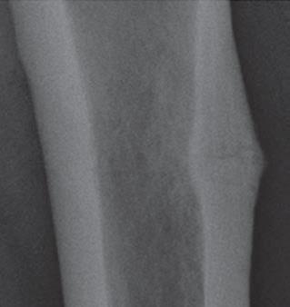 radiologist should know, HAWORTH, 2012 Diagnosis of Proximal