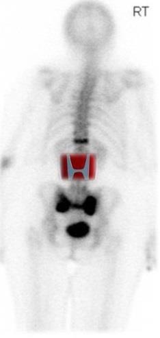 Πυέλος Νο1 παράγοντας κινδύνου: Ακτινοθεραπεία, Επιπλέον: Ολική αρθροπλαστική Ιερό Ηβικό Κοτύλη Λαγόνιο Bone scan Pelvic