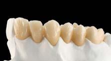 7 Συμπλήρωση των χώρων μεταξύ των 8 δοντιών μετά την πρώτη όπτηση οδοντίνης.
