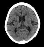 20% Cardioembolic 25% Small artery