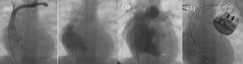 12th CONGRESS OF INNOVATIONS IN INTERVENTIONAL CARDIOLOGY & ELECTROPHYSIOLOGY SUMMARIES OF ABSTRACTS / CONGRESS PROCEEDINGS ακό αποκλεισμό είναι κατά κανόνα μονοεστιακή και επικαρδιακή.