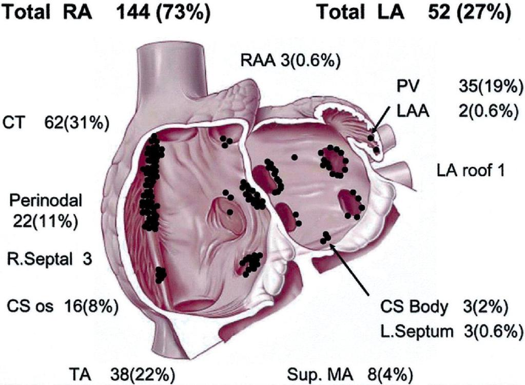 P-Wave Morphology in Focal Atrial