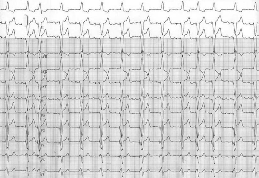 Prediction of the atrial flutter circuit location from the surface