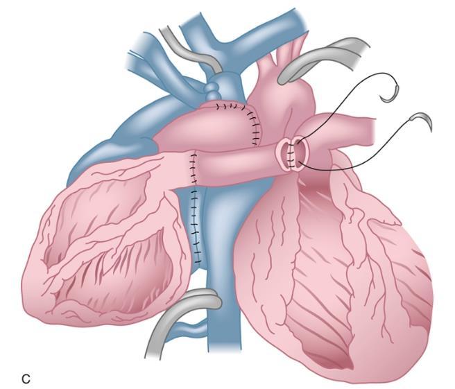 Μεταμόσχευση καρδιάς Η πιο συνηθισμένη κολπική αρρυθμία σε ασθενείς με