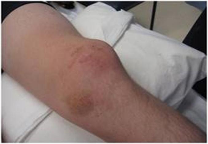REST ICE COMPRESSION ELEVATION ΞΕΚΟΥ ΑΣΘ ΡΑΓΟΣ ΕΡΙΔΕΣΘ ΑΝΥΨΩΣΘ 13.
