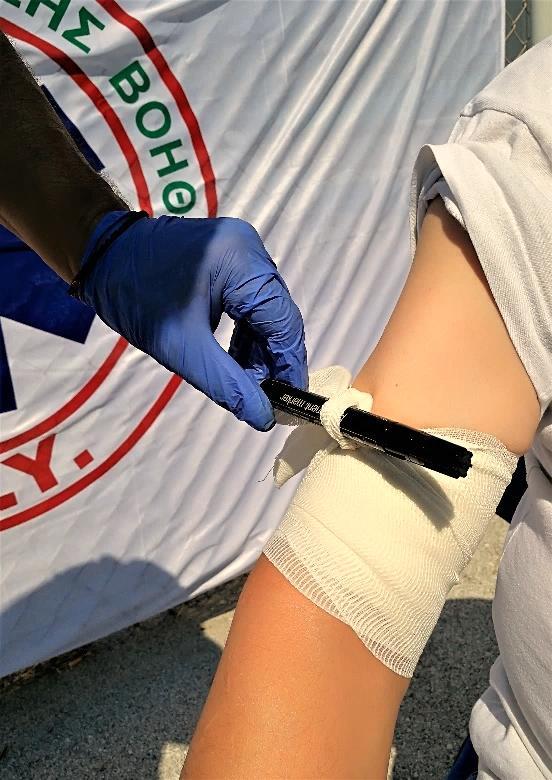 Τοποκετοφμε πάνω ςτο κόμπο ζνα κομμάτι ξφλου, ι ζνα μαρκαδόρο και ςτακεροποιοφμε το αντικείμενο με κόμπο. Γυρίηουμε γφρω- γφρω ςαν βίδα ςφιχτά μζχρι να ςταματιςει θ αιμορραγία.
