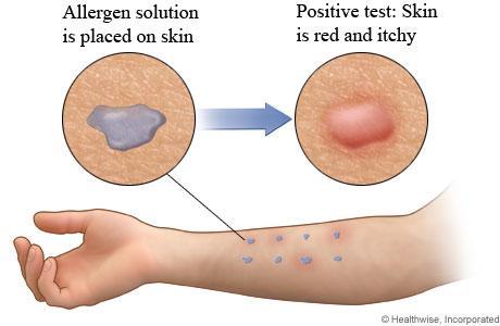 Διάγνωση WA Ανοσοενζυμική μέθοδος : IgE αντισώματα ειδικά για το συγκεκριμένο αλλεργιογόνο (ευαισθησία 83%, ειδικότητα 43%) Ειδικά δερματικά τεστ 1.