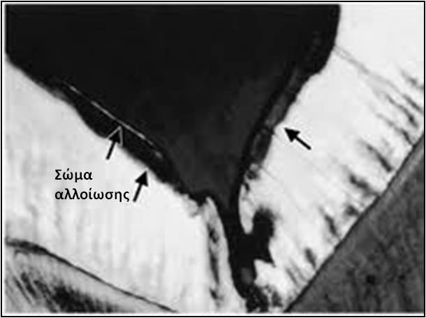 θεραπευτική αντιμετώπιση του καρκίνου κεφαλής/τραχήλου επηρεάζεται η λειτουργία αδένων και αν δεν ληφθούν αυστηρά προληπτικά μέτρα θα δημιουργηθεί η αλλοίωση (Mandel 1989).