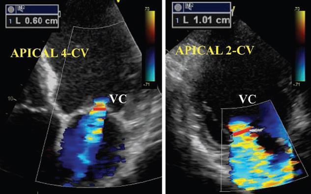 Vena contracta width Limitations Not valid for multiple jets Small values; small measurement errors leads to large % error Intermediate values need confirmation Affected by systolic changes in