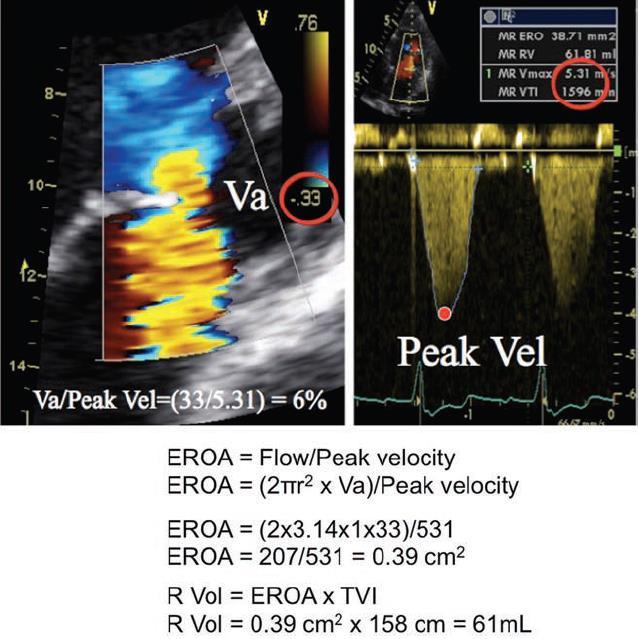Pisa Limitations Pisa shape affected: By the aliasing velocity In case of non-circular orifice (angle correction) By systolic changes in regurgitant flow By adjacent structures (flow constrinment)