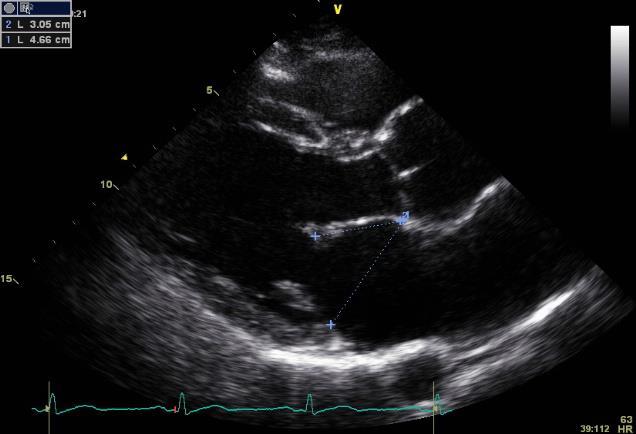 Mitral annulus Annular dilatation is present when the ratio of annular diameter to length of anterior leaflet is > 1,3 or the