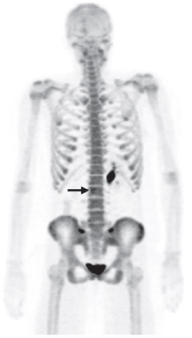Σκελετική Απεικόνιση με F-NaF PET/CT Ανίχνευση