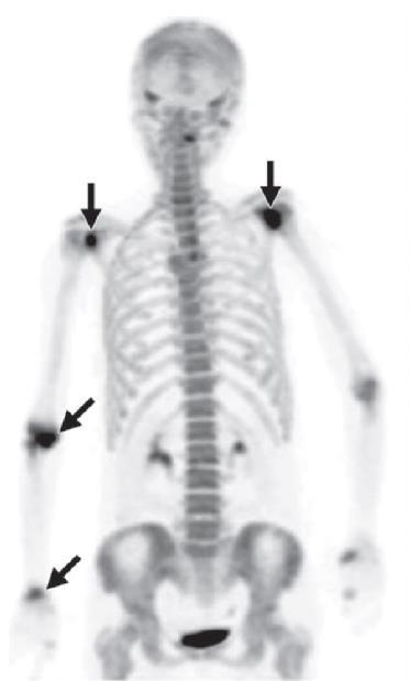 Σκελετική Απεικόνιση με F-NaF PET/CT 61
