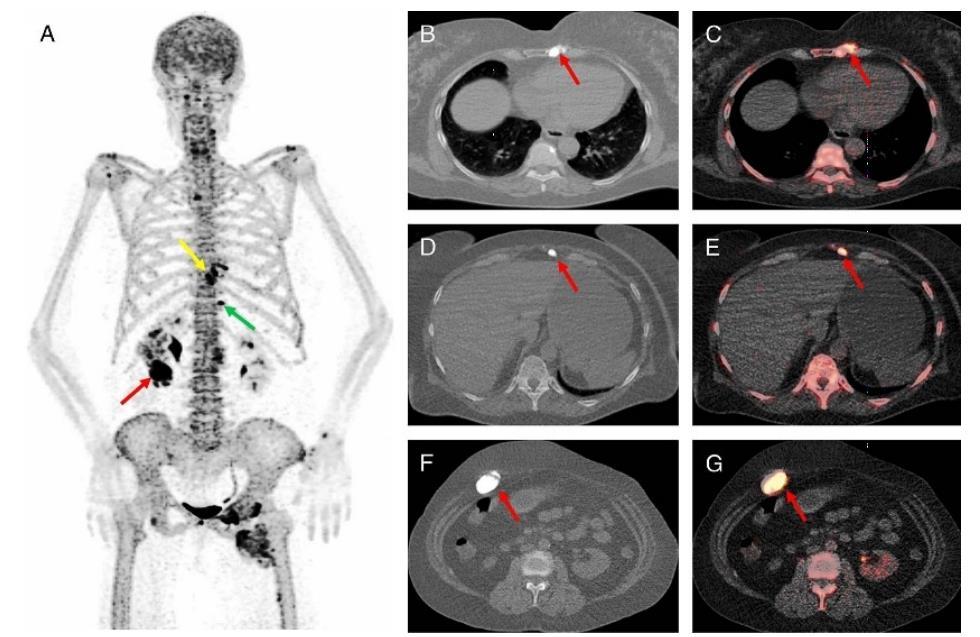 Σκελετική Απεικόνιση με F-NaF PET/CT Καλοήθη Νοσήματα των Οστών Μελορεόστωση 67 ετών γυναίκα με