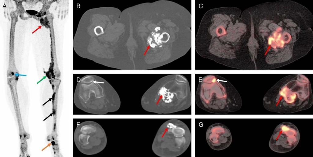 Σκελετική Απεικόνιση με F-NaF PET/CT Καλοήθη Νοσήματα των